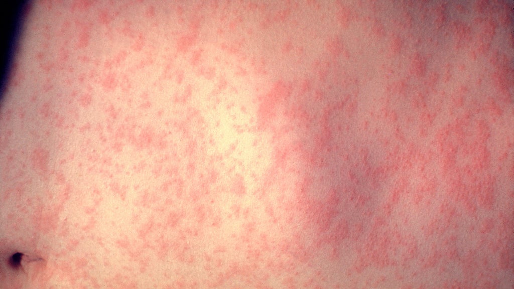 25 cases of measles identified in central, southeastern Minnesota, MDH says — WCCO / CBS Minnesota, Shoreview Health news
